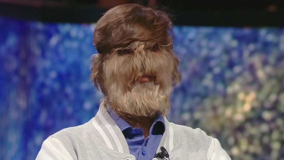 Homem com síndrome do lobisomem ganha fama na internet