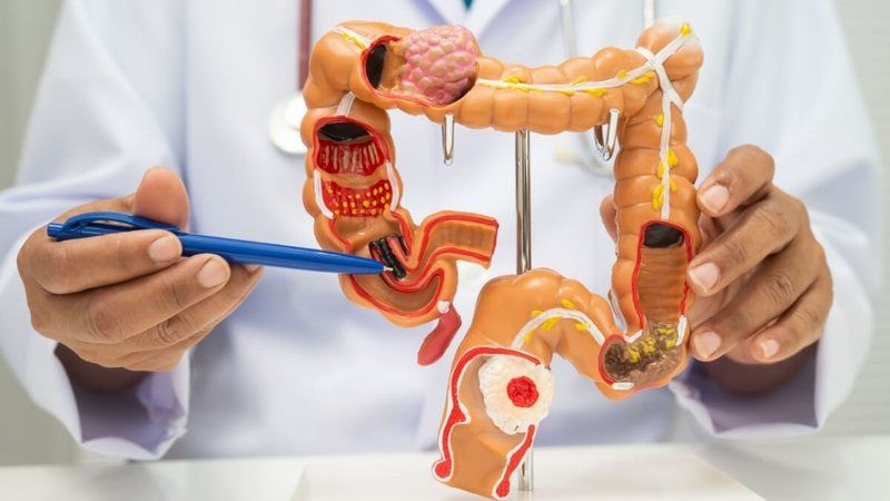 Câncer colorretal e o consumo de ultraprocessados