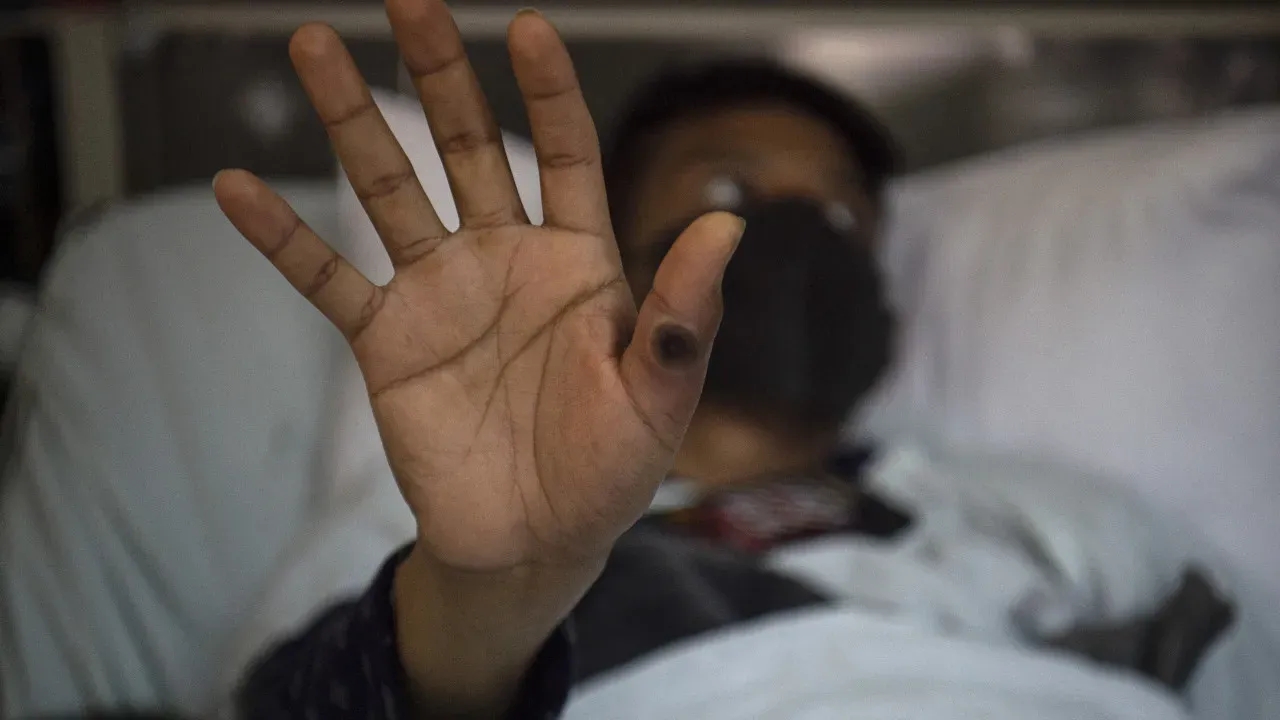 Nova variante de Mpox é identificada no Brasil